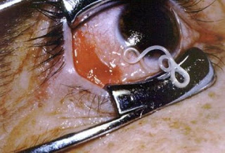 Αφαίρεσαν από ανθρώπινο μάτι,ένα ολοζώντανο σκουλήκι... στο Νοσοκομείο του Ρίου!!!