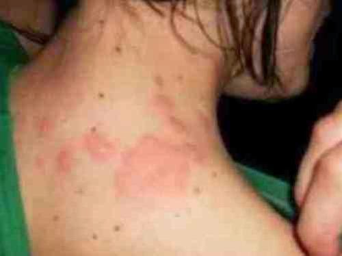 Chagas το νέο AIDS!!!