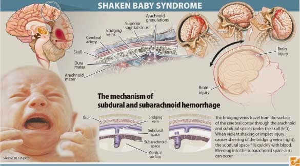 Τι είναι το σύνδρομο ανατάραξης μωρού: Μην ταρακουνάτε ποτέ το μωρό σας!!! (video)