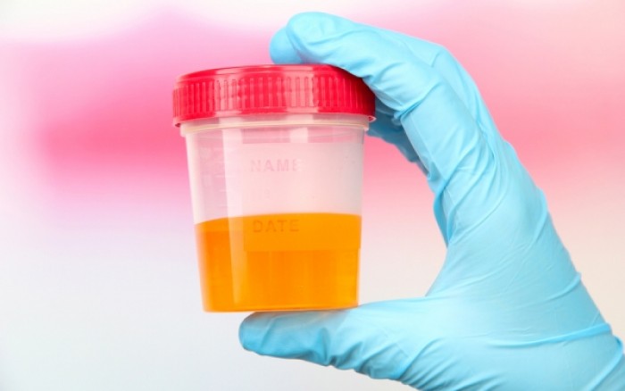 Χρώμα ούρων: Τι δείχνει για την υγεία σας 