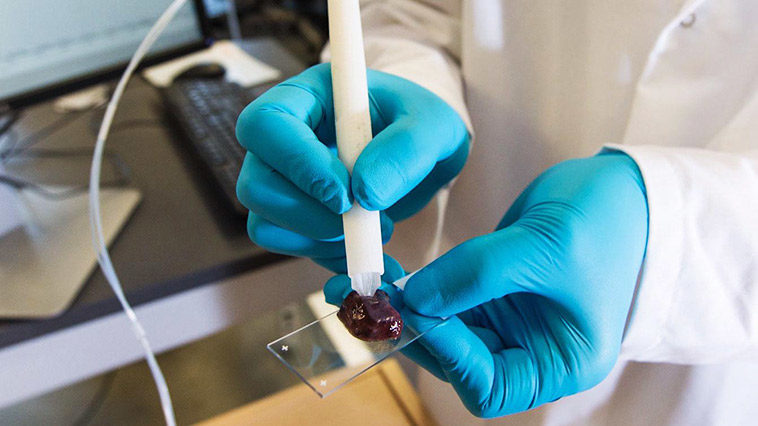 «Στυλό» για χειρουργούς εντοπίζει τον καρκίνο εντός δευτερολέπτων…